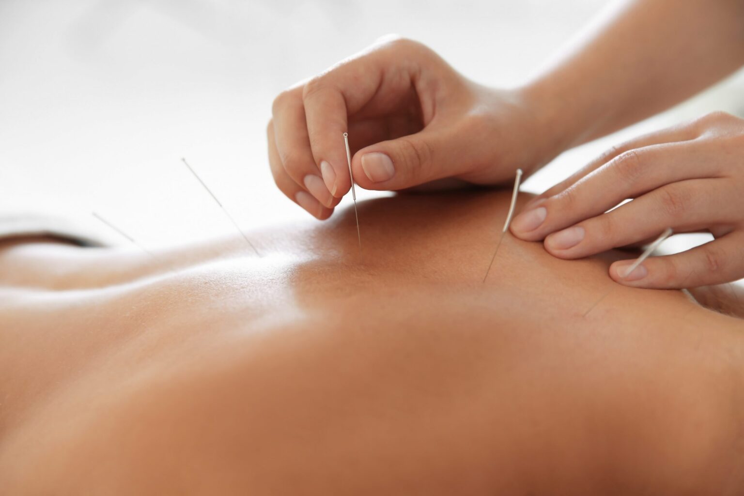 Acupuncture treatment